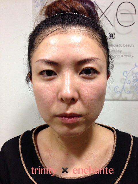 Read more about the article 【３０代前半】ハーブ３g×５回施術のビフォーアフター写真