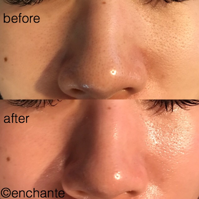 Read more about the article ハーブ療法で1回で劇的な変化！20代女性